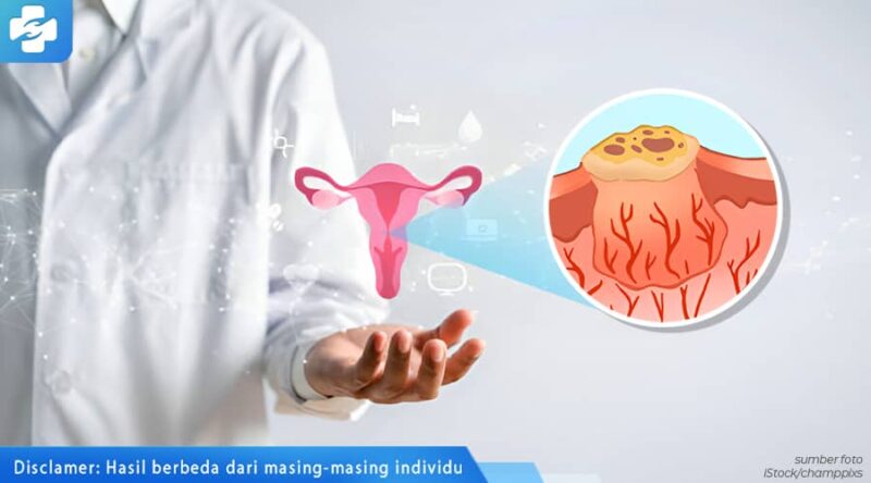 Jangan Panik Ini 3 Cara Atasi Benjolan Di Vagina Yang Efektif Klinik