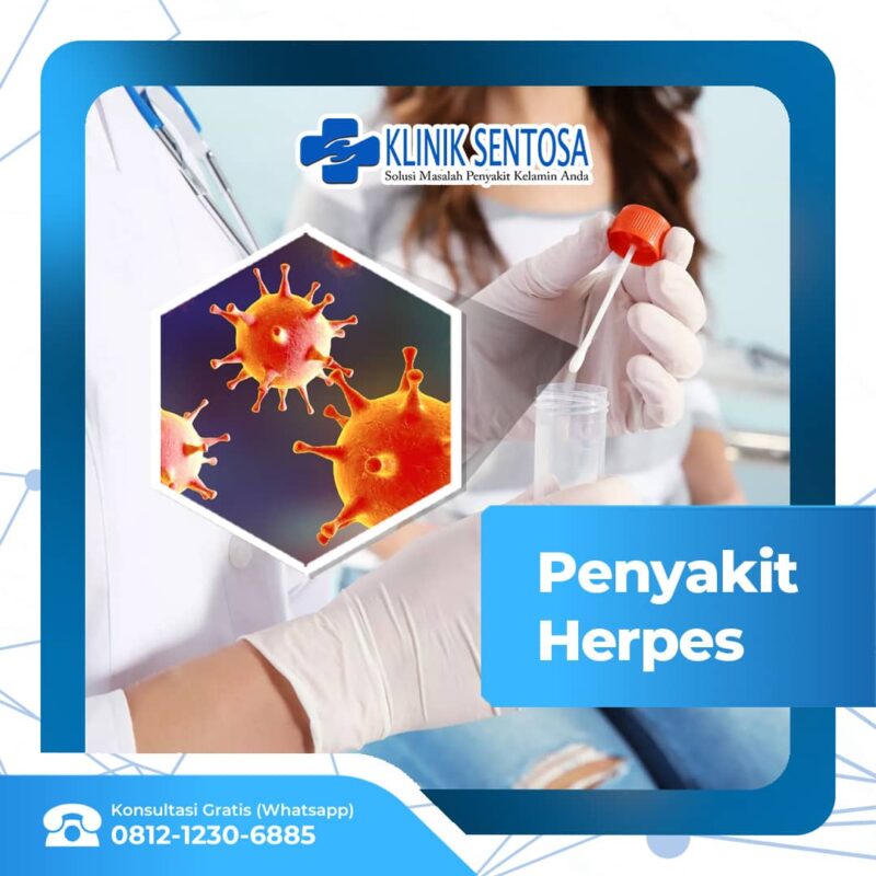 Penyakit Herpes: Bagaimana Cara Penyembuhannya? – Klinik Utama Sentosa