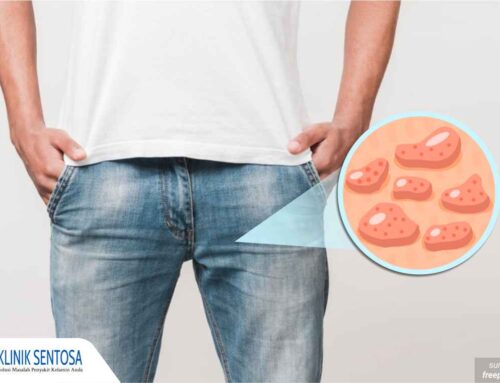 Gawat! Kutil Kelamin Bertambah Banyak dan Mengganggu? Cek, Ini Cara Mengatasinya!