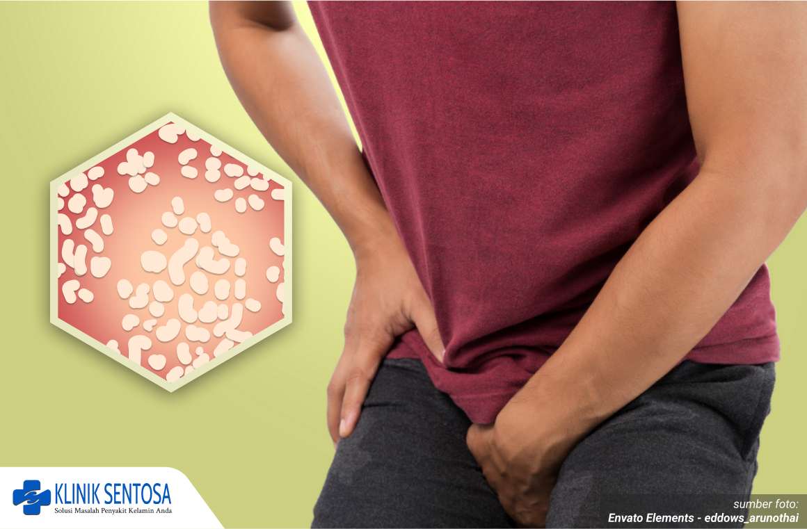 infeksi jamur pada penis 1_1_11zon