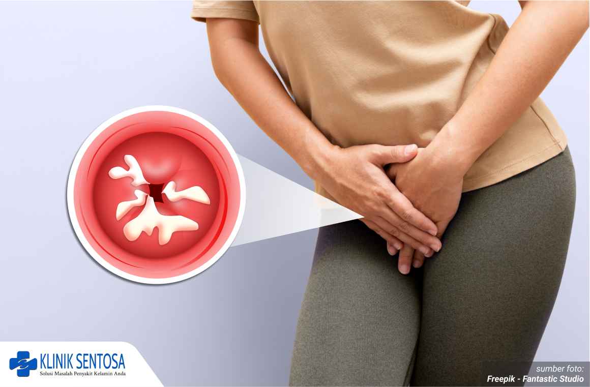 cara mengatasi keputihan gatal 1_1_11zon