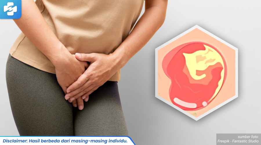 gejala keputihan karena jamur 2_1_11zon