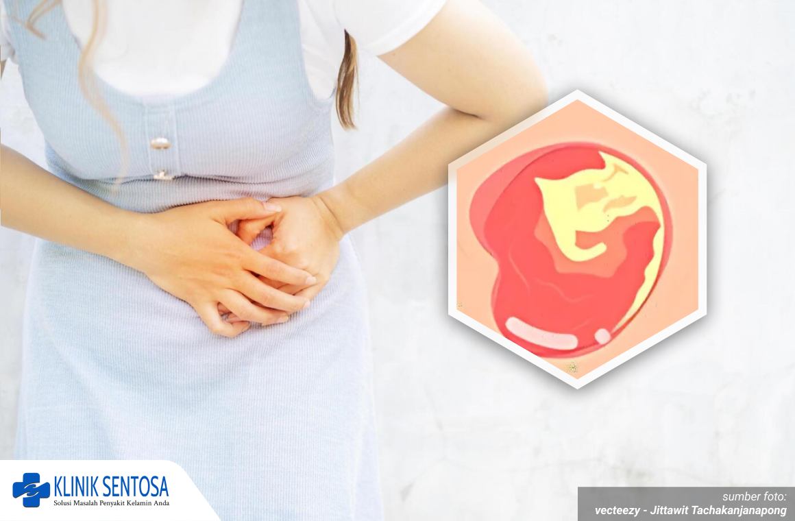 Mengobati Keputihan 1_3_11zon