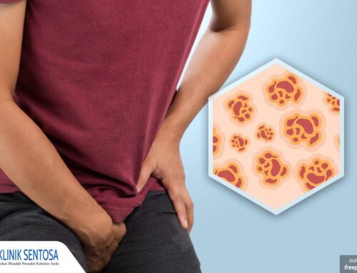 Berbagai Metode Pengobatan Kondiloma Akuminata, Mana yang Paling Ampuh?