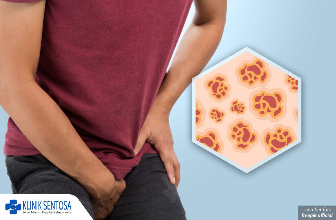 pengobatan kondiloma akuminata 1_1_11zon