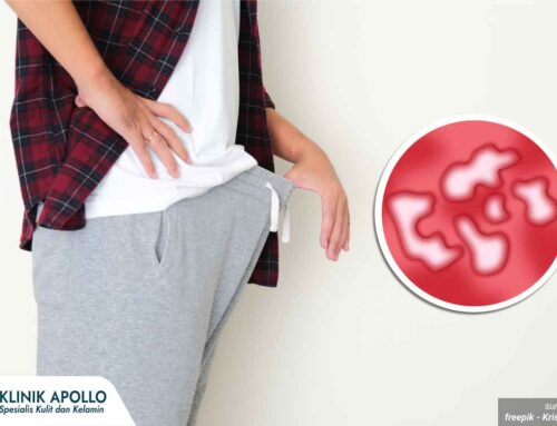 Sudah Masuk Fase Ini? Awas Penyakit Sifilis Bisa Merusak Organ Tubuh!