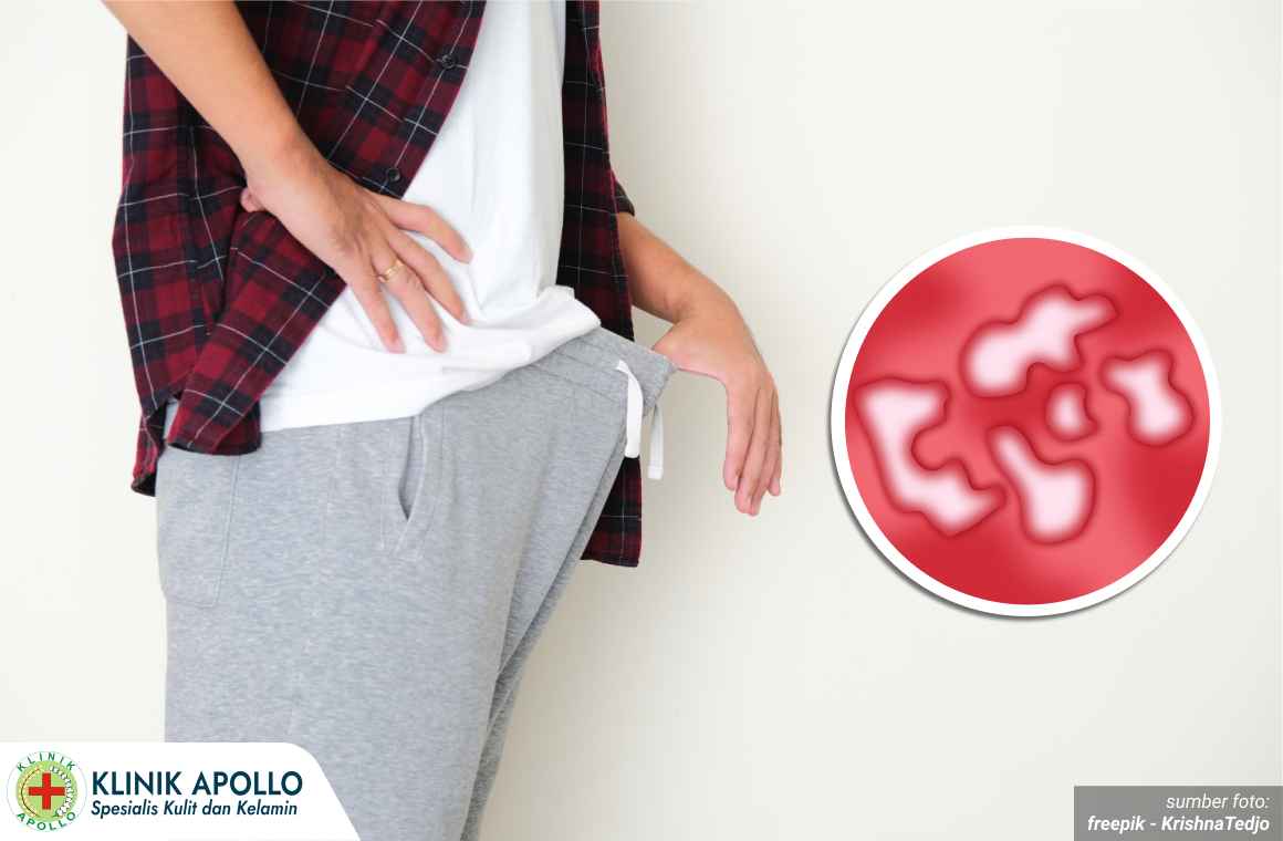 fase penyakit sifilis 1_3_11zon