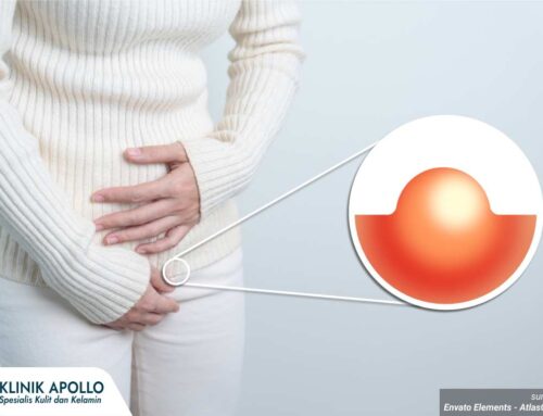 Kista di Bibir Vagina Membesar? Jangan Tunggu Pecah, Cek Segera!