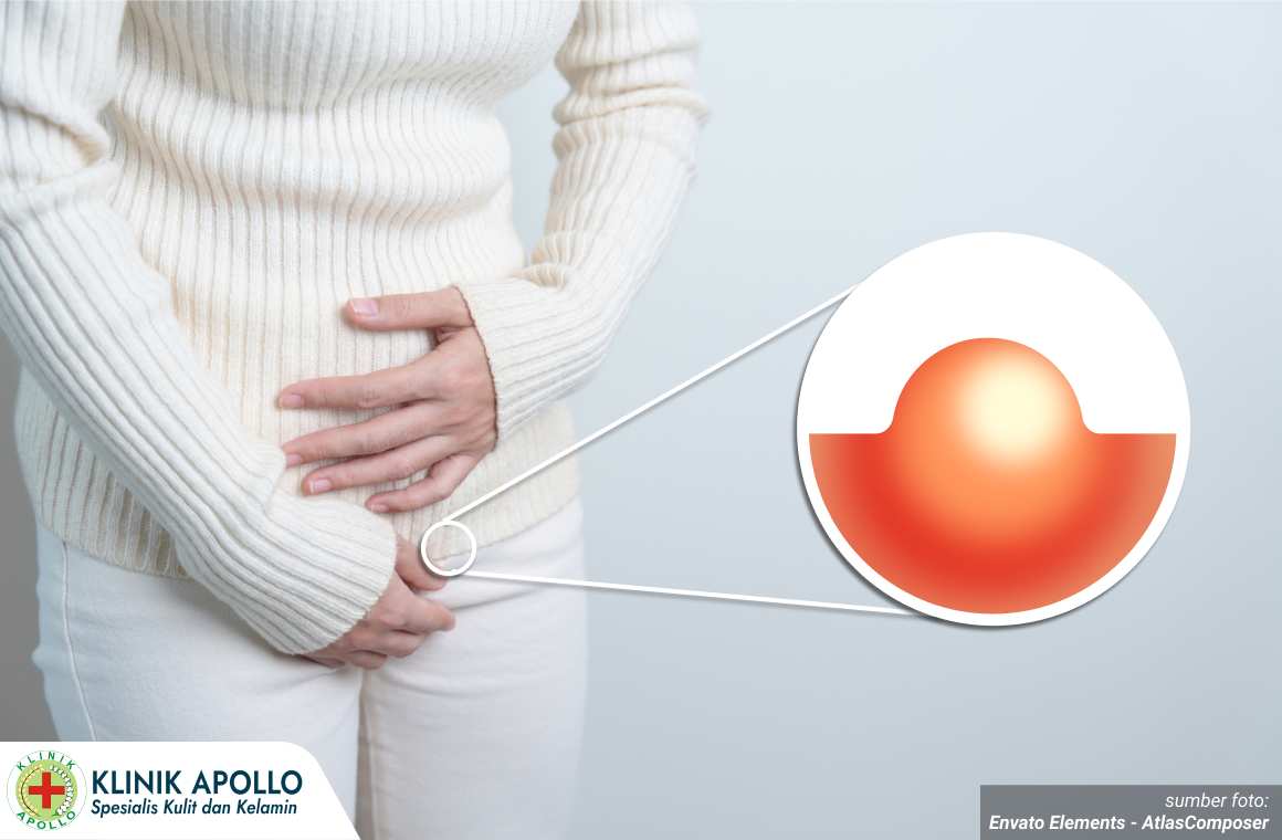 kista di bibir vagina 1_2_11zon