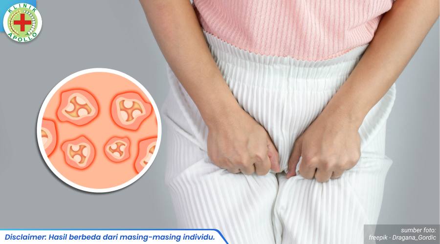 kondiloma akuminata parah 2_6_11zon