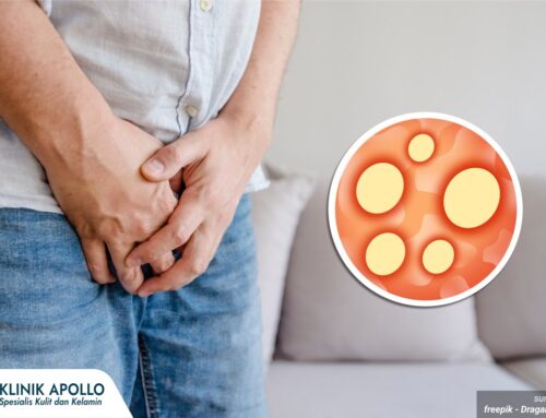 Sifilis Stadium Lanjut, Masih Bisakah Disembuhkan? Ini Penjelasan Dokter