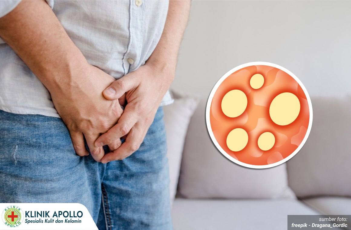 sifilis stadium lanjut 1_5_11zon