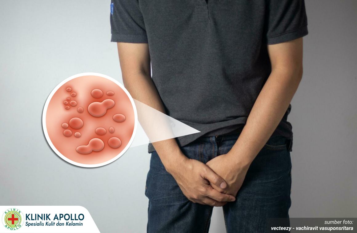 Ciri Benjolan Kutil pada Pria 1_6_11zon