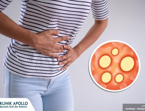 Muncul Luka pada Kelamin? Jangan Diabaikan, Bisa Tanda Infeksi Raja Singa!