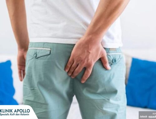 Cara Hilangkan Kutil di Anus dengan Prosedur Modern, Mana yang Lebih Efektif? Cek Yuk!