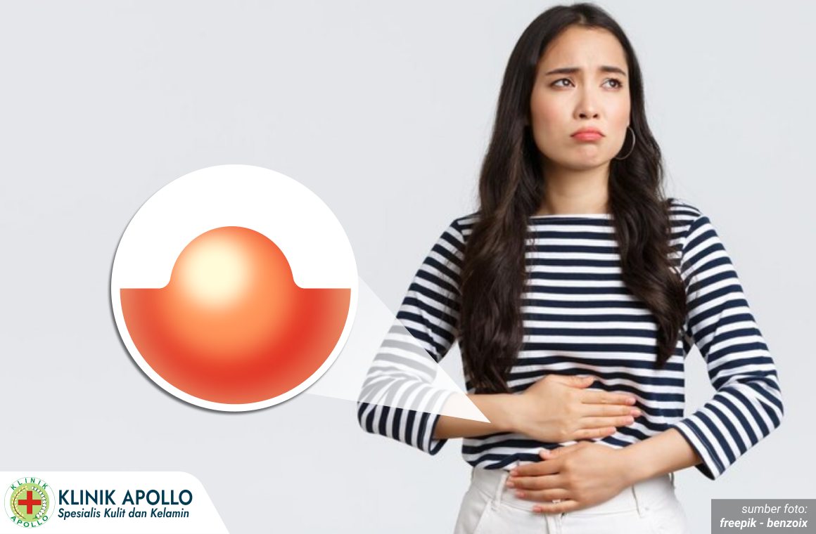 cara menyembuhkan kista bartholin 1_6_11zon