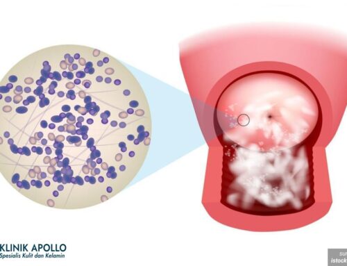 Bau Tak Sedap dan Gatal? Jamur di Kemaluan Bisa Jadi Penyebabnya!