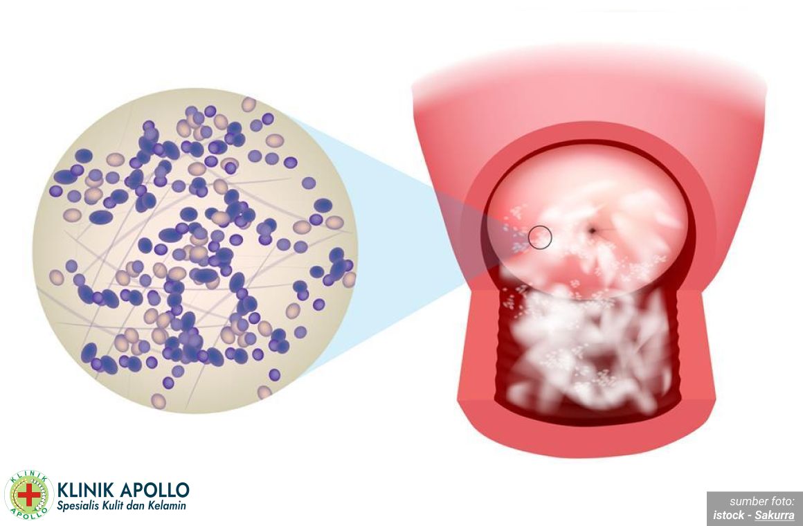 jamur di kemaluan 1_6_11zon