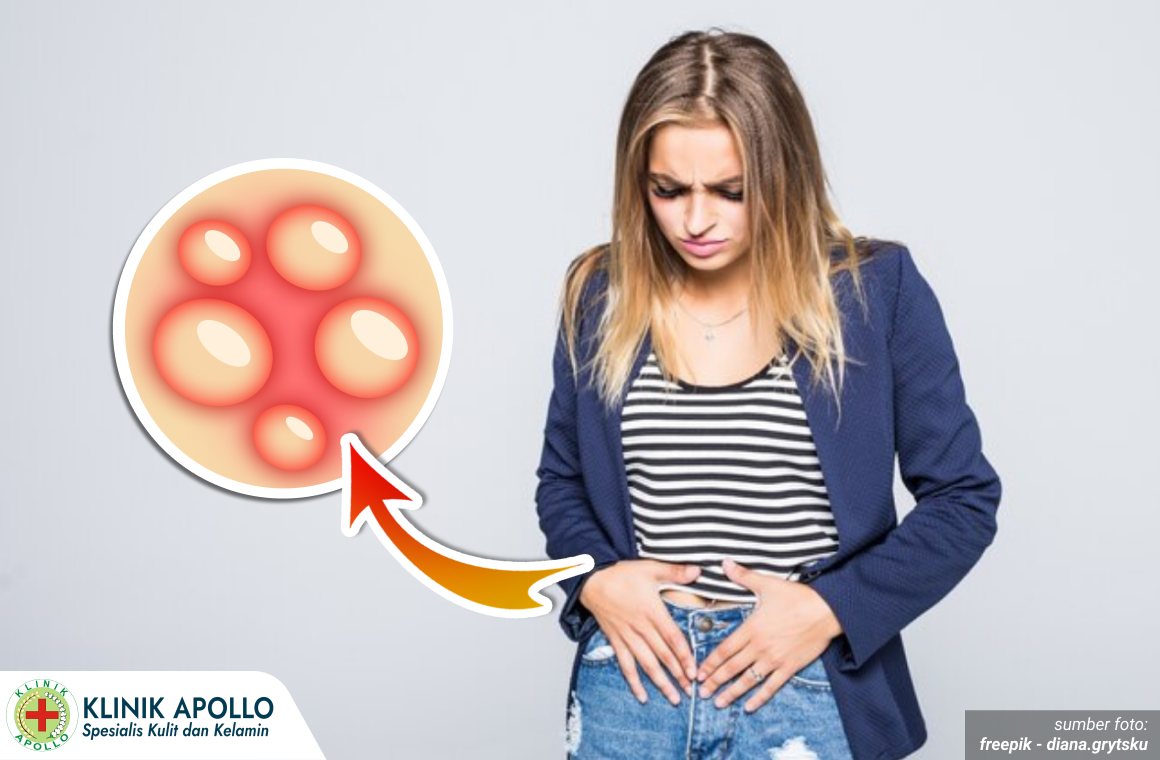 lepuh herpes kelamin kering 1_5_11zon