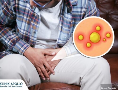 Waspada Benjolan Berisi Nanah di Kelamin, Ini Penyebabnya